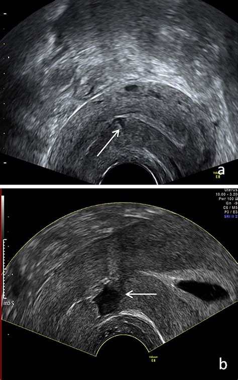 uterine scar dehiscence ultrasound